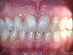 natürlichen Zahnfarbe der Patientin - in diesem Falle VITA A2) Patientin wü...